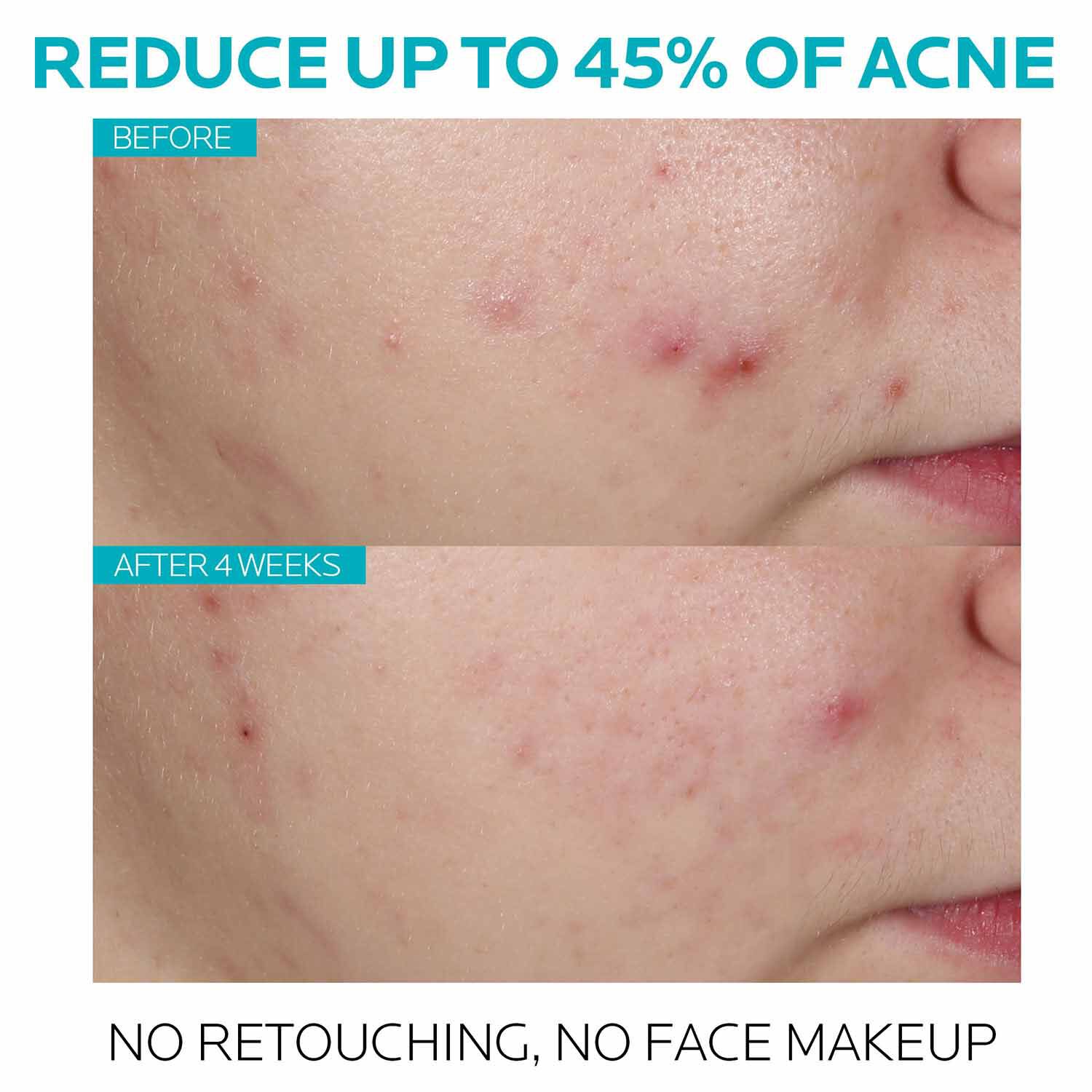7_EffaclarSerum_After-45-days.jpg